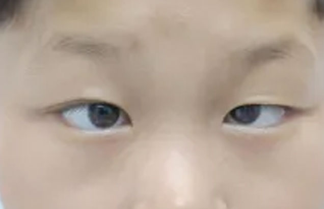 China-Singapore Light: Sharing Love and Supporting Children with Strabismus on their path to proper vision